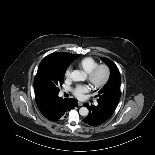 Obstructing sigmoid adenocarcinoma (Radiopaedia 58465-65619 A 3).jpg