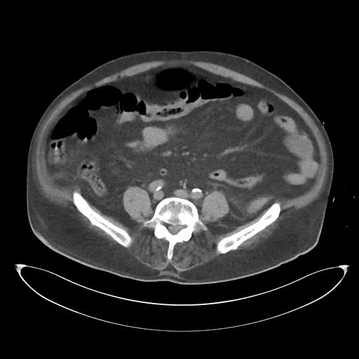 File:Obstructive pyelonephritis (Radiopaedia 46411-50844 Axial non-contrast 50).png