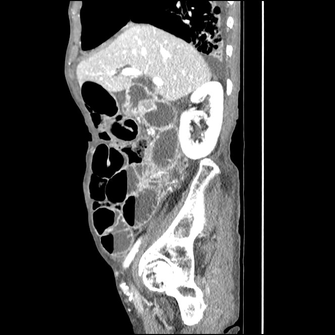 Obturator hernia causing small bowel obstruction (Radiopaedia 65522-74612 C 70).jpg