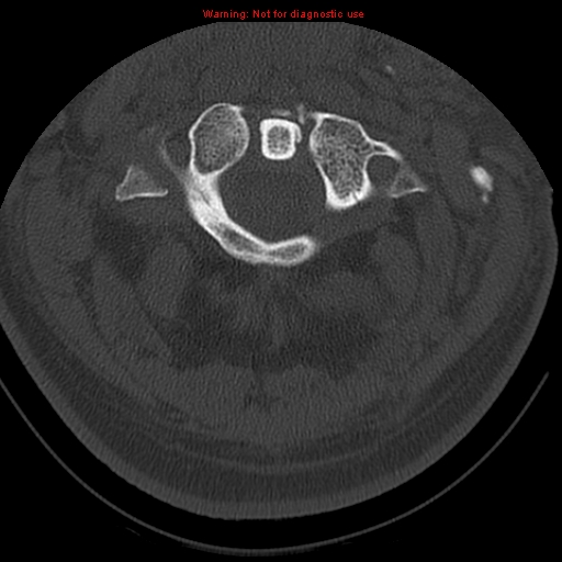 File:Occipital condyle fracture (Radiopaedia 18366-18208 Axial bone window 18).jpg