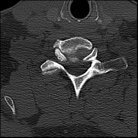 Occipital condyle fracture (type 1) (Radiopaedia 87670-104084 Axial bone window 71).jpg