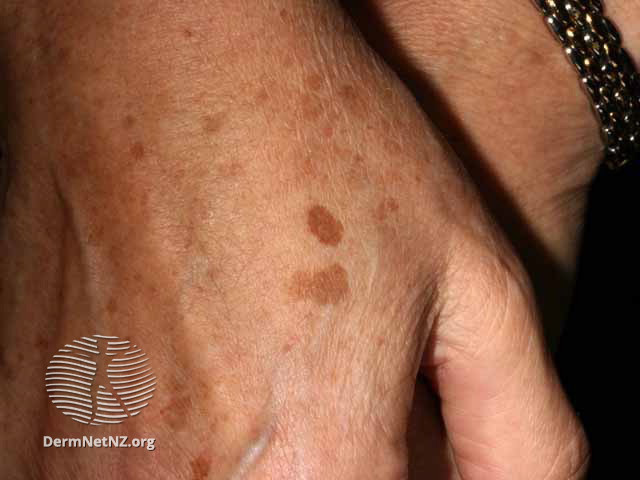 File:Solar lentigo (DermNet NZ lesions-s-solar-lentigo-20).jpg