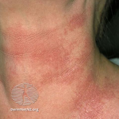 File:(DermNet NZ dermatitis-acd-face-2442).jpg