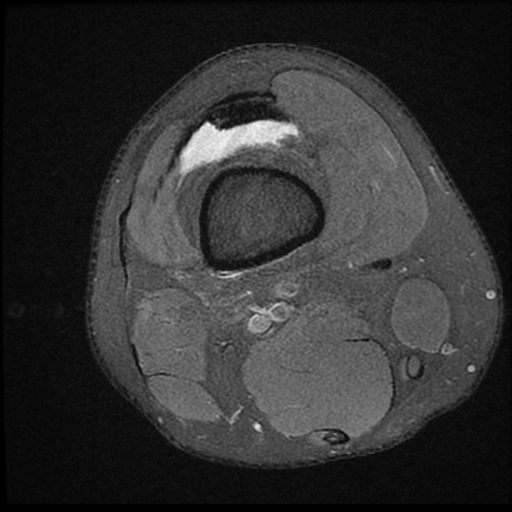 File:ACL acute full thickness tear - deep lateral femoral sulcus sign (Radiopaedia 38594-40740 Axial PD fat sat 1).jpg