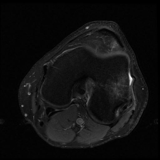 File:ACL and meniscal tears (Radiopaedia 79604-92797 Axial PD fat sat 13).jpg