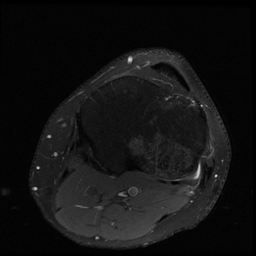 File:ACL and meniscal tears (Radiopaedia 79604-92797 Axial PD fat sat 19).jpg