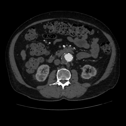 File:Abdominal aortic aneurysm (Radiopaedia 57318-64259 Axial C+ arterial phase 35).jpg