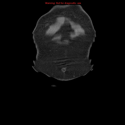 Abdominal aortic aneurysm (Radiopaedia 8190-9038 Coronal C+ arterial phase 2).jpg