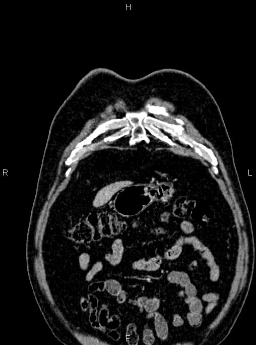 Abdominal aortic aneurysm (Radiopaedia 83094-97462 Coronal renal cortical phase 16).jpg