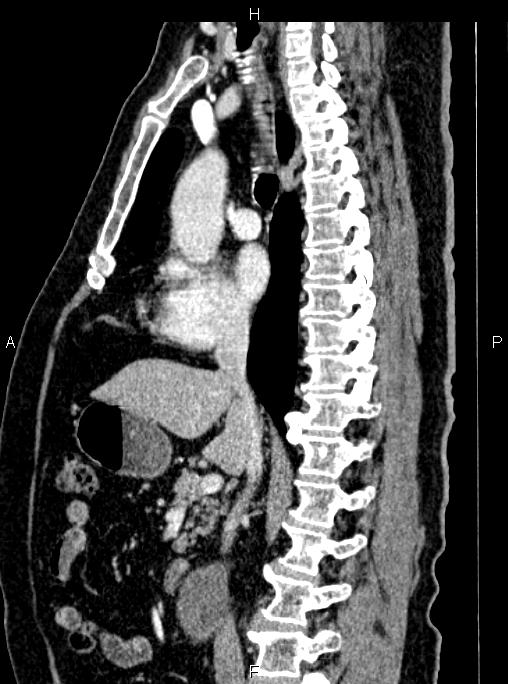 Abdominal aortic aneurysm (Radiopaedia 83094-97462 Sagittal renal cortical phase 59).jpg