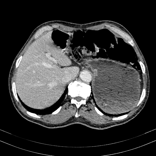 Abdominal aortic aneurysm (Radiopaedia 83581-98689 Axial C+ portal venous phase 21).jpg