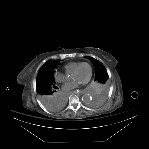 File:Abdominal aortic aneurysm - impending rupture (Radiopaedia 19233-19247 Axial non-contrast 17).jpg