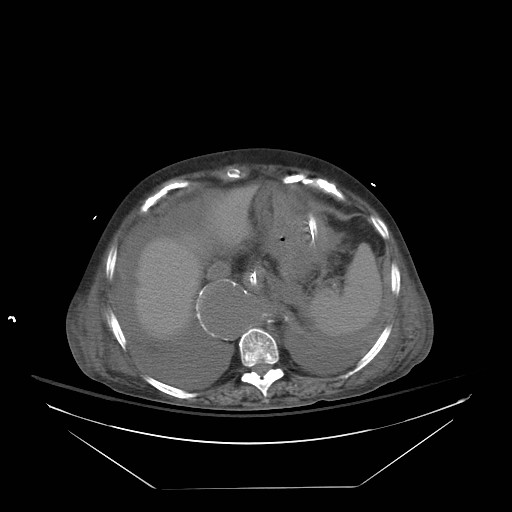 Abdominal aortic aneurysm - impending rupture (Radiopaedia 19233-19247 Axial non-contrast 35).jpg