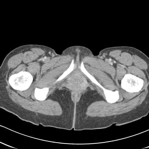 File:Abdominal desmoid tumor (Radiopaedia 41007-43740 Axial C+ portal venous phase 78).png