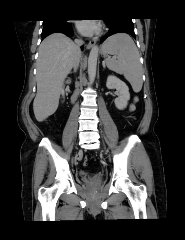 Abdominal lymphoma - with sandwich sign (Radiopaedia 53486-59492 C+ portal venous phase 23).jpg