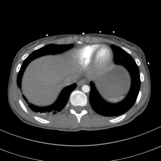File:Abdominal multi-trauma - devascularised kidney and liver, spleen and pancreatic lacerations (Radiopaedia 34984-36486 Axial C+ arterial phase 68).png