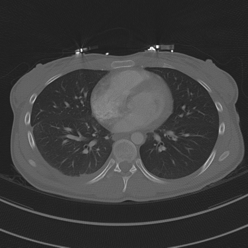 File:Abdominal multi-trauma - devascularised kidney and liver, spleen and pancreatic lacerations (Radiopaedia 34984-36486 I 53).png