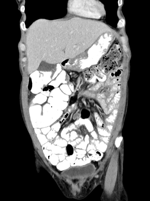 Abdominal wall and retroperitoneal tuberculosis (Radiopaedia 88137-104729 Coronal C+ portal venous phase 26).jpg