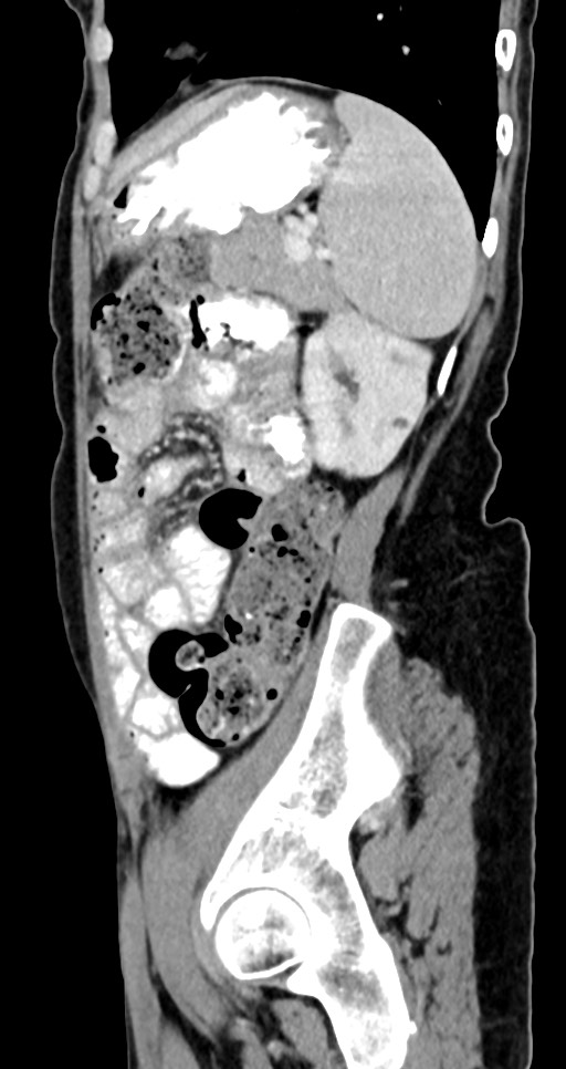 Abdominal wall and retroperitoneal tuberculosis (Radiopaedia 88137-104729 Sagittal C+ portal venous phase 42).jpg
