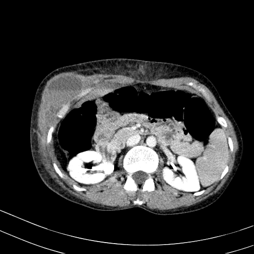 Abdominal wall hematoma with active bleeding (Radiopaedia 83915-99117 Axial C+ portal venous phase 21).jpg