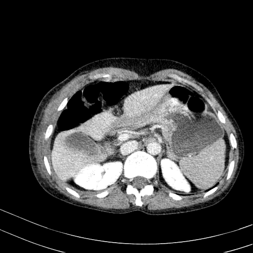 Abdominal wall hematoma with active bleeding (Radiopaedia 83915-99117 Axial C+ portal venous phase 4).jpg