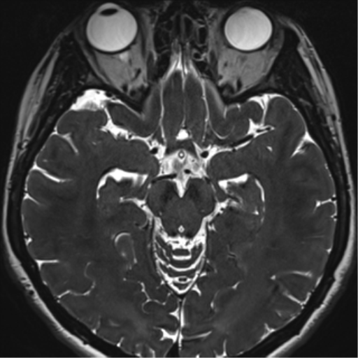 File:Abducens nerve palsy (Radiopaedia 51069-56648 Axial T2 fat sat 66).png