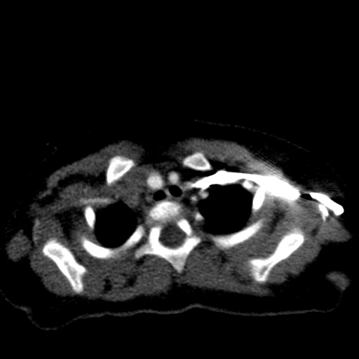 File:Aberrant left pulmonary artery (pulmonary sling) (Radiopaedia 42323-45435 Axial C+ CTPA 9).jpg