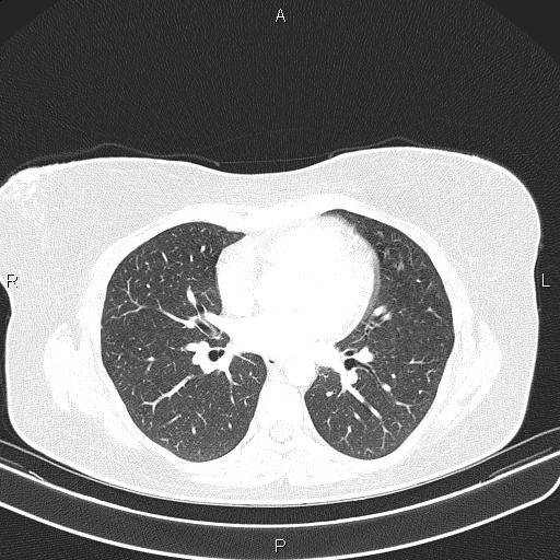 File:Aberrant right subclavian artery (Radiopaedia 87334-103629 Axial lung window 37).jpg