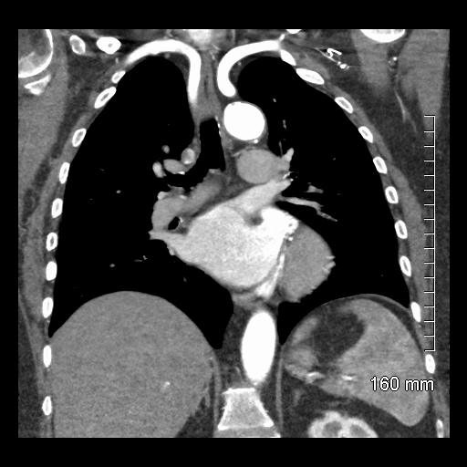 Aberrant right subclavian artery stenosis (Radiopaedia 52656-58670 B 51).jpg