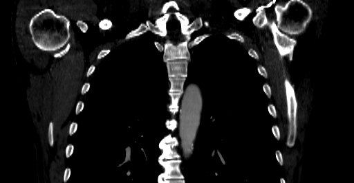 Accesory rib joint (Radiopaedia 71987-82452 Coronal bone window 23).jpg