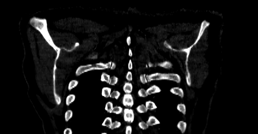 Accesory rib joint (Radiopaedia 71987-82452 Coronal bone window 78).jpg