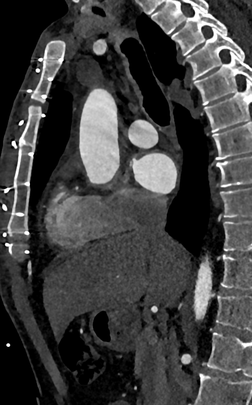 Accessory left atrial appendage (Radiopaedia 81987-95968 Sagittal C+ arterial phase 36).jpg