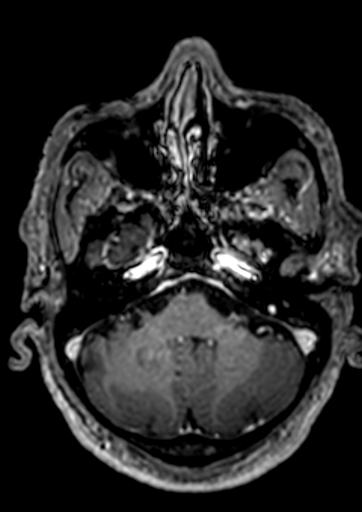 Accessory middle cerebral artery (Radiopaedia 73114-83828 Axial T1 C+ 135).jpg