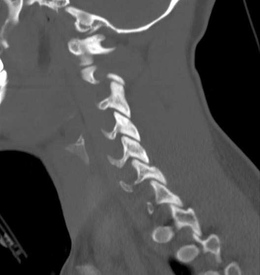 File:Accessory ossicle of the anterior arch of C1 vertebra (Radiopaedia 58149-65211 Sagittal bone window 16).jpg
