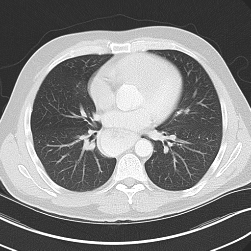 Achalasia of the cardia (Radiopaedia 38497-40595 Axial lung window 30).png