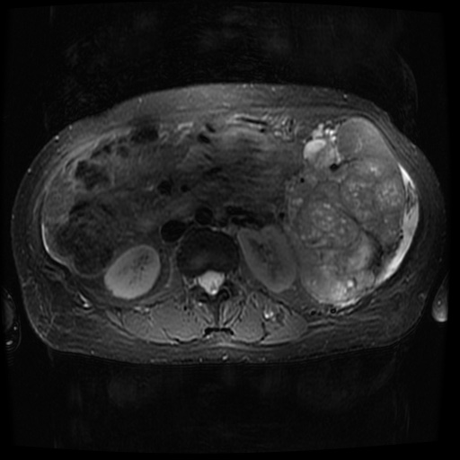 Acinar cell carcinoma of the pancreas (Radiopaedia 75442-86668 Axial T2 fat sat 42).jpg