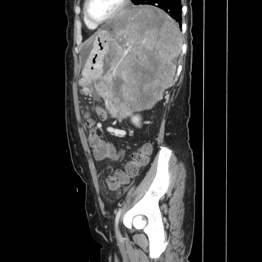 File:Acinar cell carcinoma of the pancreas (Radiopaedia 75442-86669 Sagittal C+ portal venous phase 137).jpg