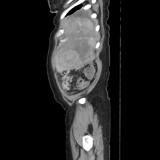 Acinar cell carcinoma of the pancreas (Radiopaedia 75442-86669 Sagittal C+ portal venous phase 171).jpg