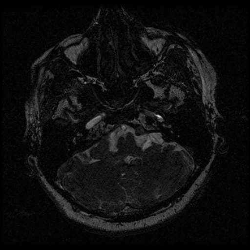 File:Acoustic schwannoma (Radiopaedia 33045-34060 Axial T2 14).png