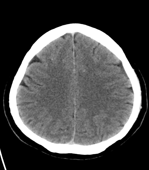 File:Acoustic schwannoma (Radiopaedia 33045-34065 Axial non-contrast 20).png