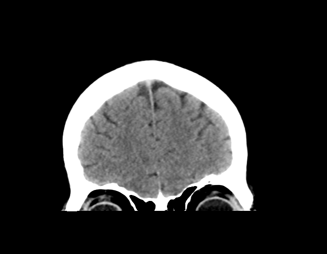 File:Acoustic schwannoma (Radiopaedia 33045-34065 Coronal non-contrast 11).png