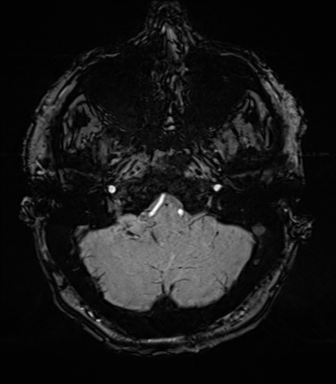 Acoustic schwannoma (Radiopaedia 50846-56358 Axial SWI 15).png