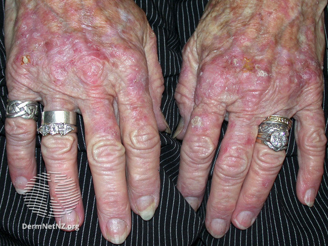 File:Actinic keratoses affecting the hands (DermNet NZ lesions-ak-hands-475).jpg