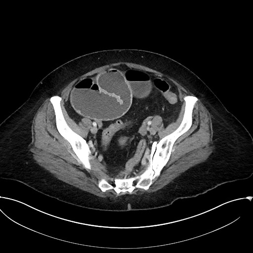 Active Crohn disease (Radiopaedia 59394-66750 Axial C+ portal venous phase 58).jpg