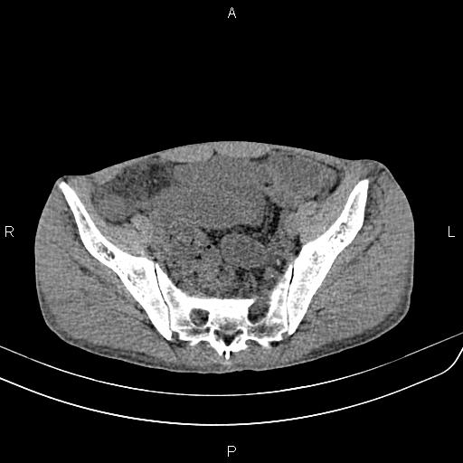 Active crohn disease (Radiopaedia 87133-103397 Axial non-contrast 83).jpg