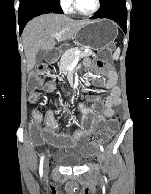Active crohn disease (Radiopaedia 87133-103397 Coronal C+ arterial phase 22).jpg