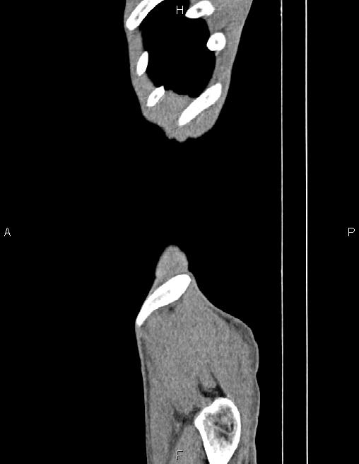 Active crohn disease (Radiopaedia 87133-103397 Sagittal C+ arterial phase 1).jpg