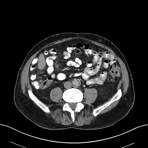 File:Active lower gastrointestinal bleeding - diverticular (Radiopaedia 61203-69106 Axial C+ portal venous phase 76).jpg