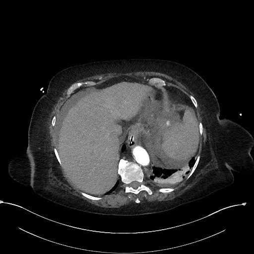 File:Active renal extravasation with large subcapsular and retroperitoneal hemorrhage (Radiopaedia 60975-68796 Axial 155).jpg
