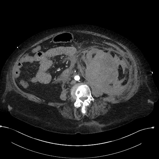 File:Active renal extravasation with large subcapsular and retroperitoneal hemorrhage (Radiopaedia 60975-68796 Axial C+ arterial phase 106).jpg